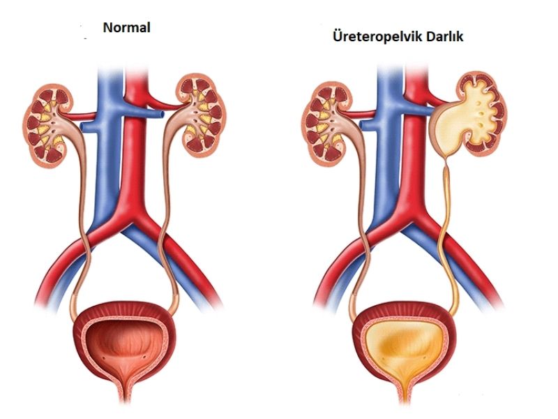 üreteropelvik bileşke darlığı